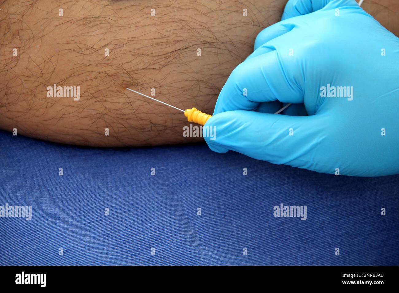 Electromyography EMG and Somatosensory Evoked Potential PEV of lower