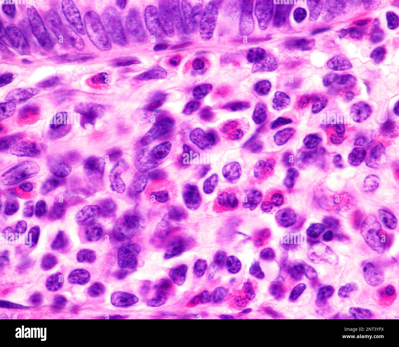 Light microscope micrograph showing eosinophil granulocytes in the
