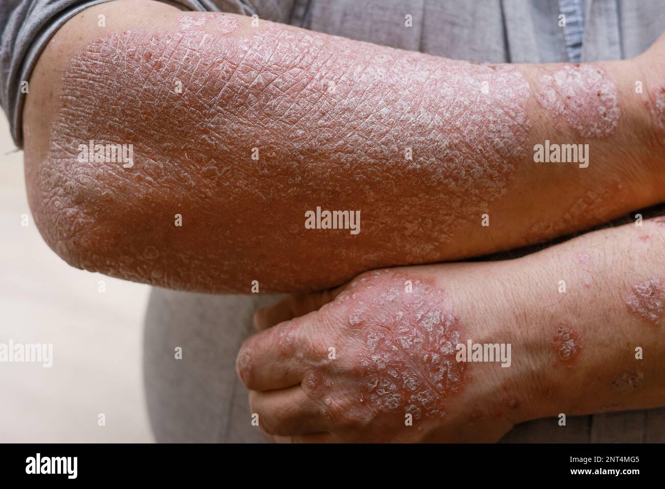 Dry cracked skin on legs best sale