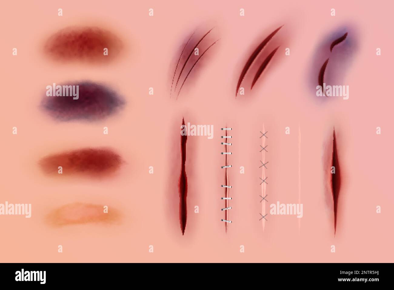 Set with isolated scares injures seams realistic icons of abrasions and