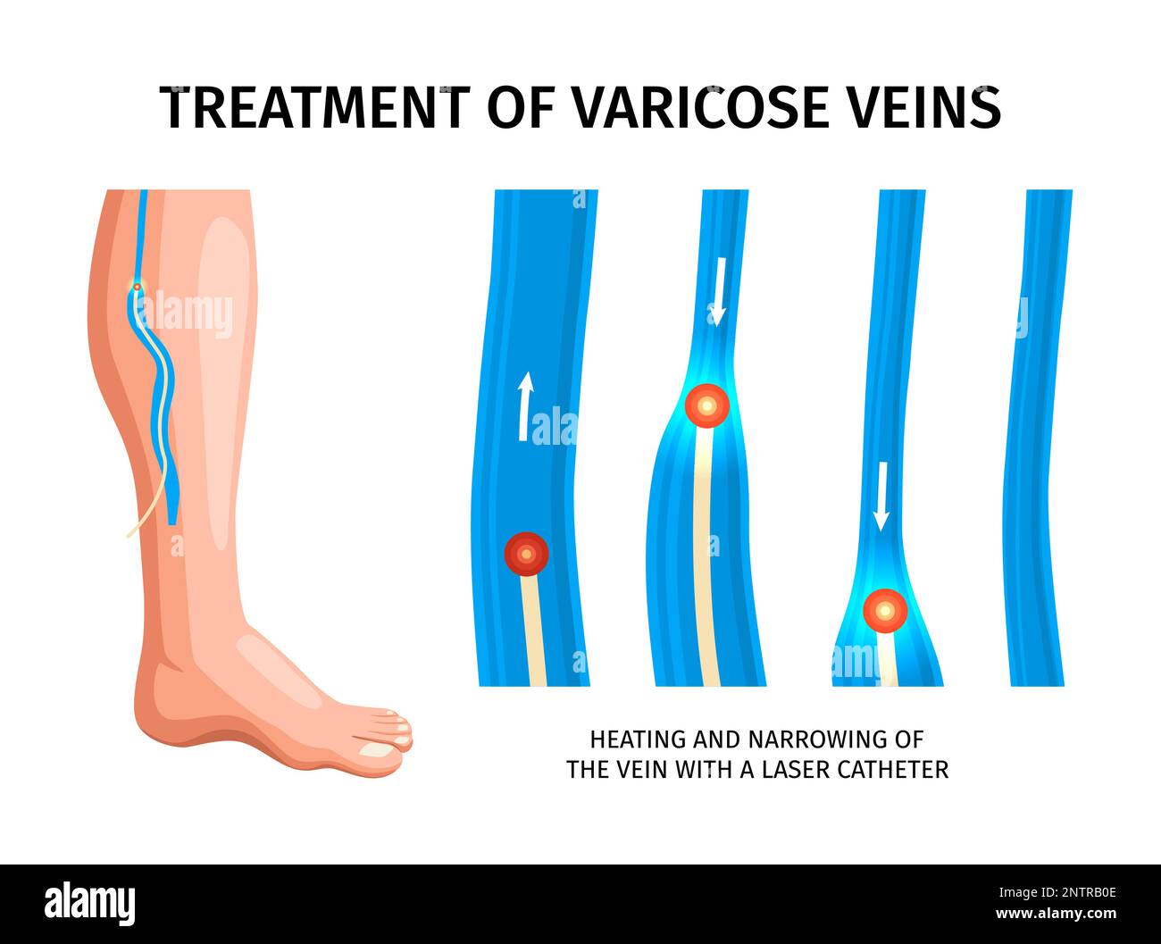 Treatment of varicose veins infographics poster depicting heating and