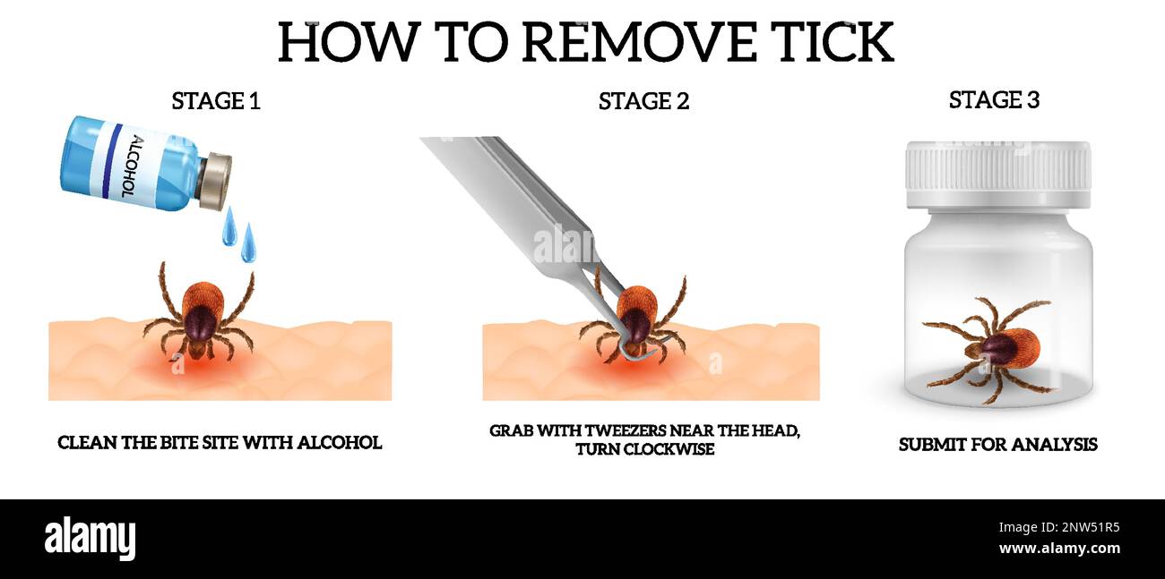 Realistic spider mite remove infographics with three stages of how to remove tick vector illustration Stock Vector