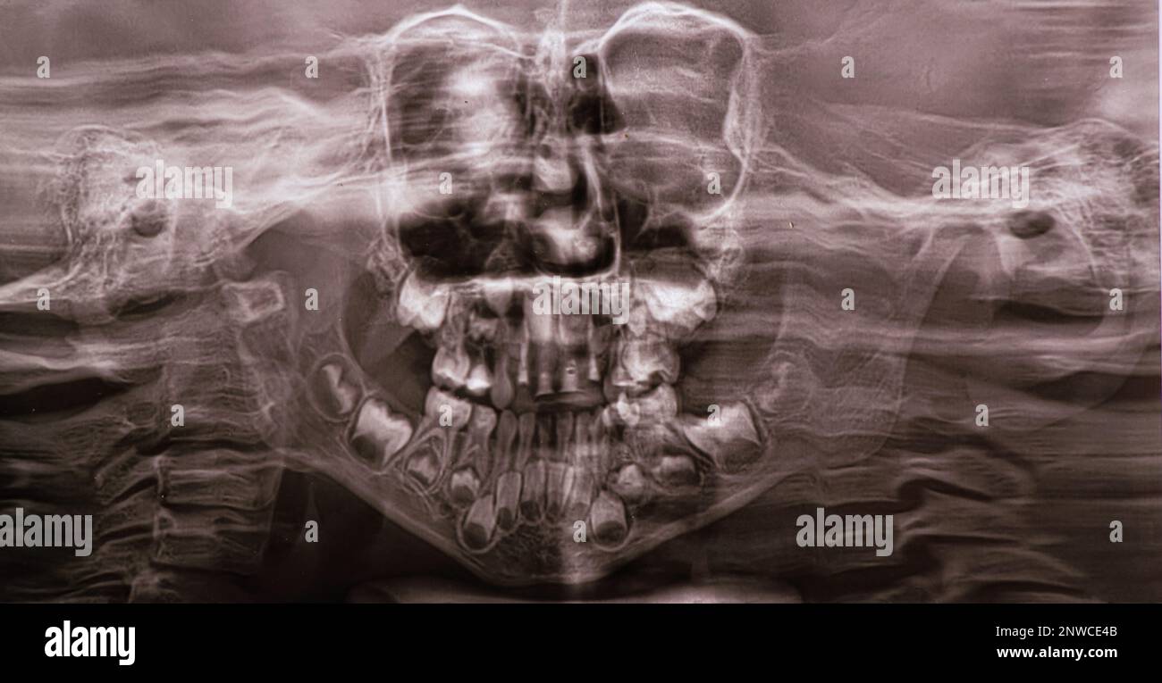 A panoramic X-ray shows several embedded and impacted teeth on both the