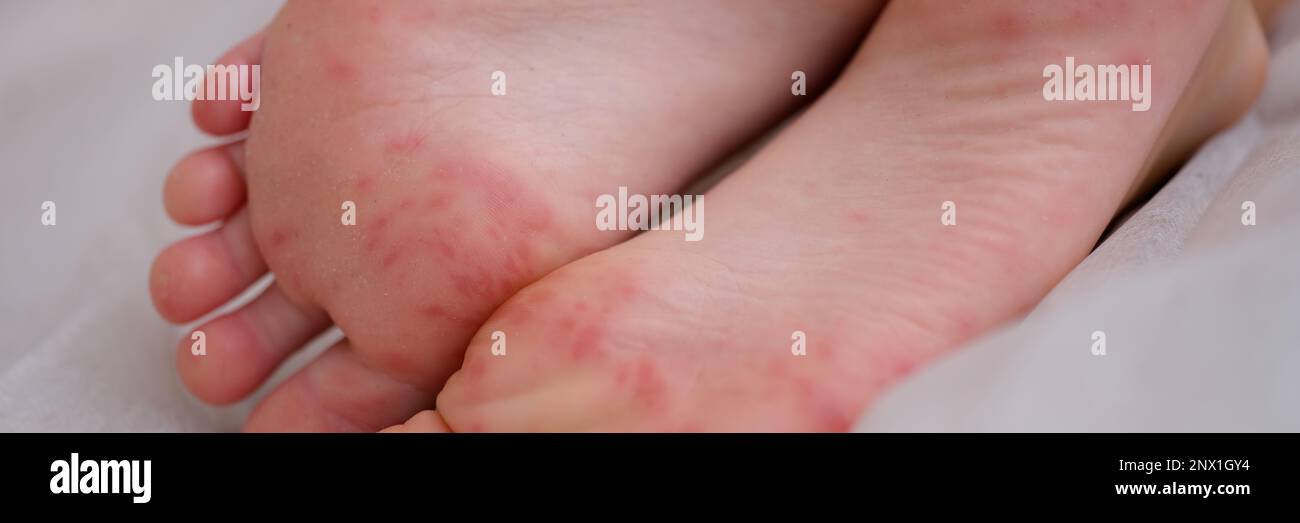 Painful rash red spots blisters on child leg Stock Photo