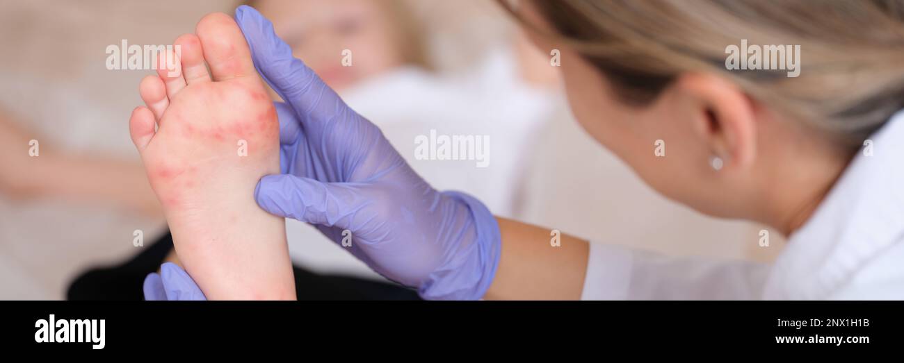 Doctor conducts medical examination of leg of child with red itchy rash closeup Stock Photo Alamy