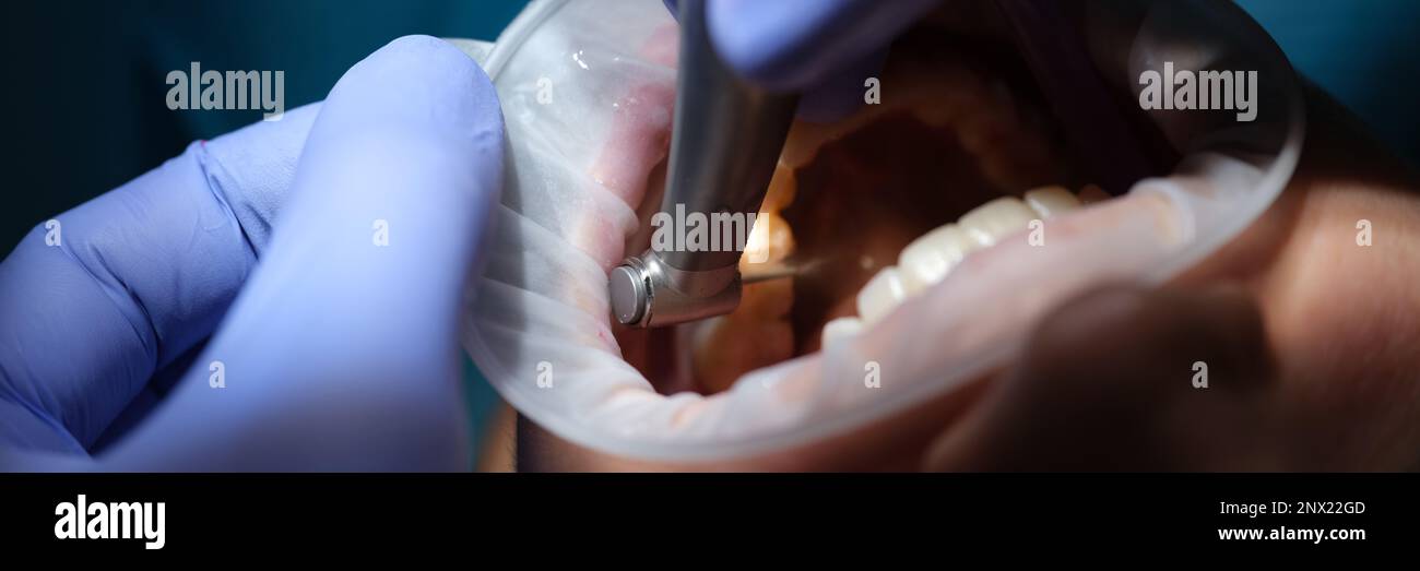 Dentist drills tooth to patient in dental chair closeup Stock Photo - Alamy