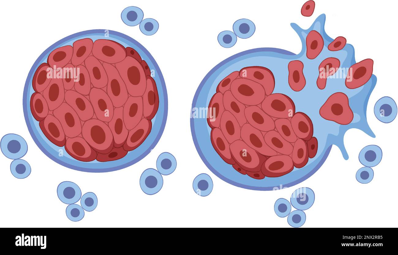 Tumor Cell And Cancer Development Illustration Stock Vector Image And Art Alamy