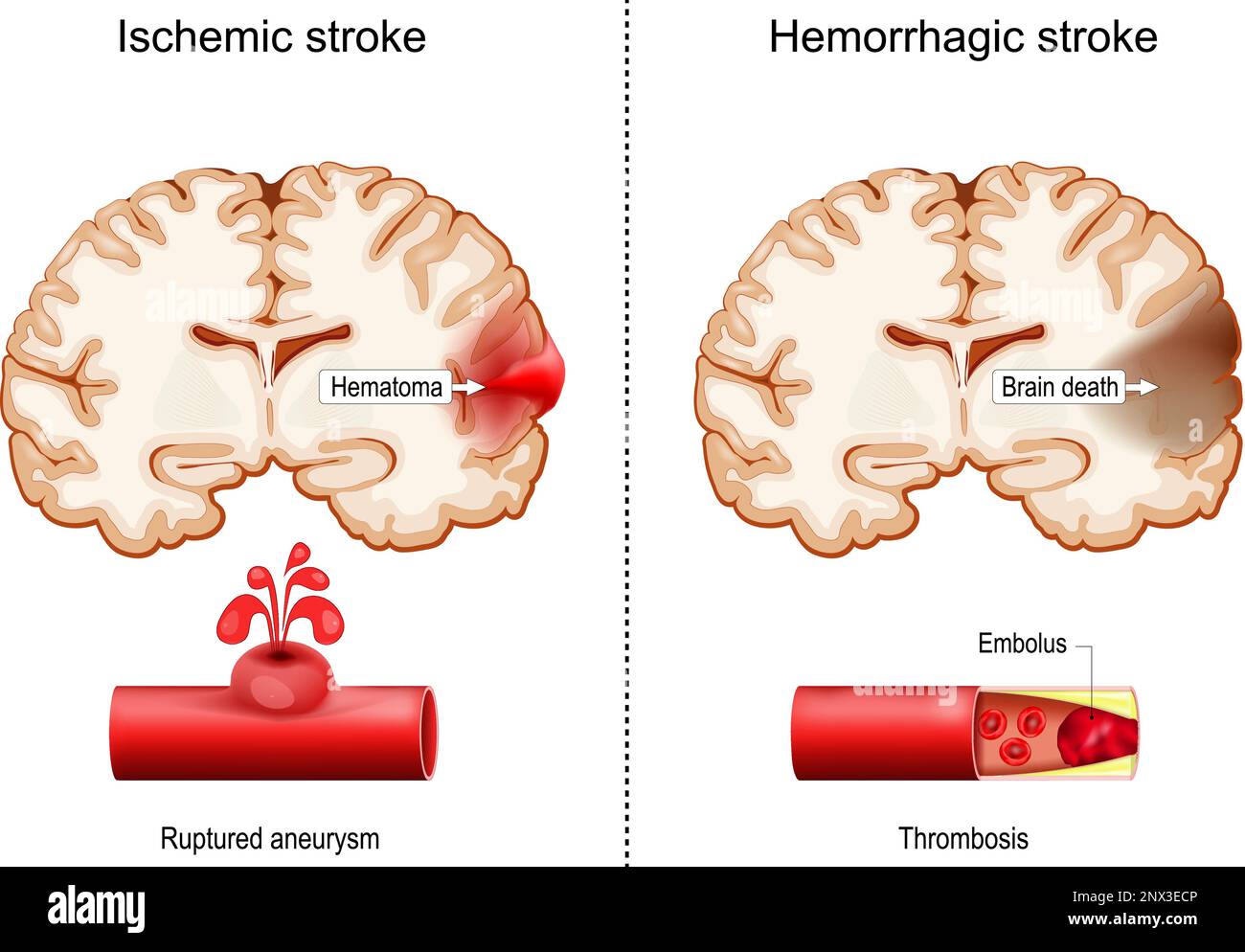 Hemorrhagic and Ischemic strokes. Cross sections of human brain with Hematoma and part of Brain death.  close-up of blood vessel Stock Vector