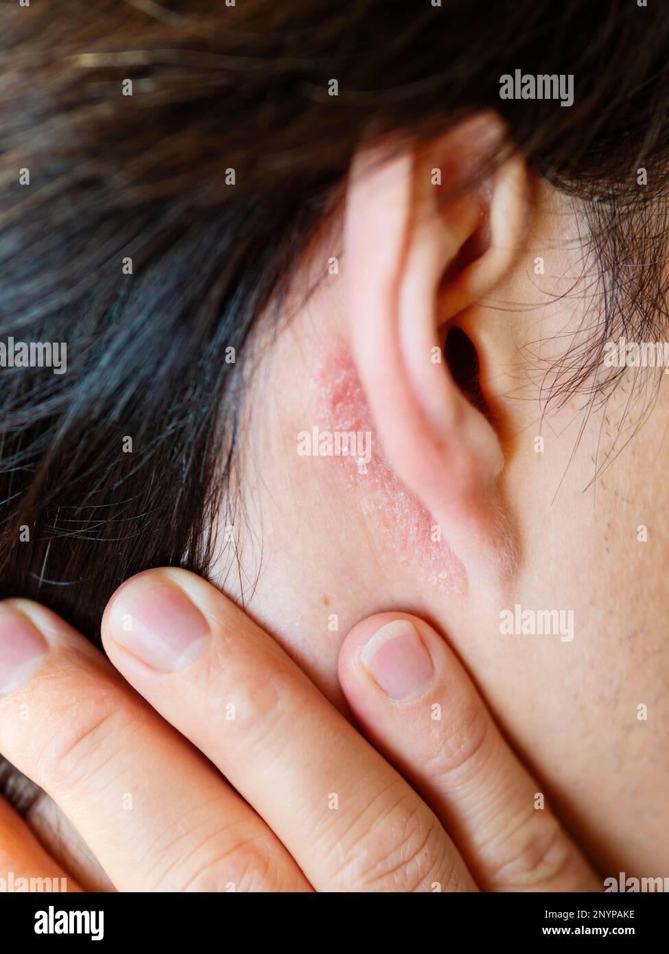 Irritation on the skin behind the ear. Man with flaky skin. Allergy or