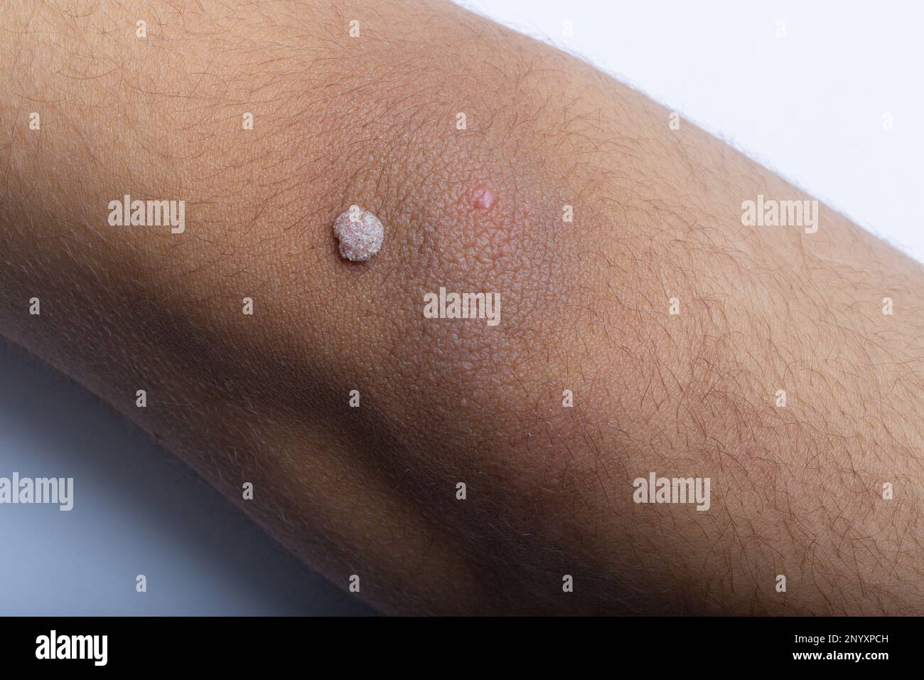 Teenage Boy with Wart on Arm: Causes, Treatment, and Prevention Stock Photo