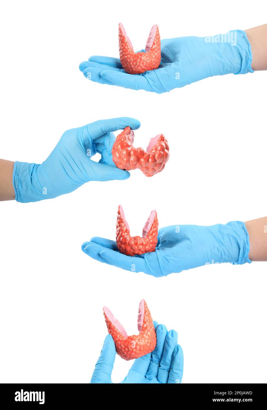 Doctors holding plastic models of healthy and afflicted thyroid on white background, closeup. Collage Stock Photo