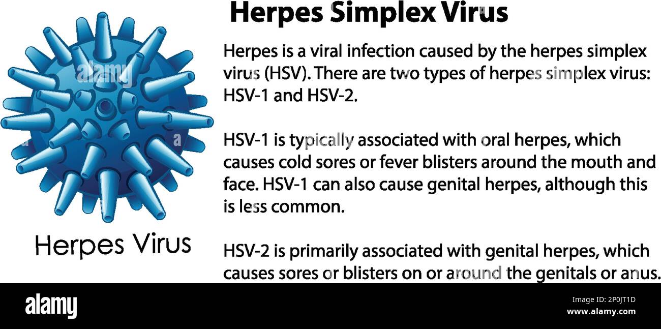 What Kind Of Herpes Does Nba Have What Can Trigger An Outbreak Of The Herpes Simplex Virus at Alan