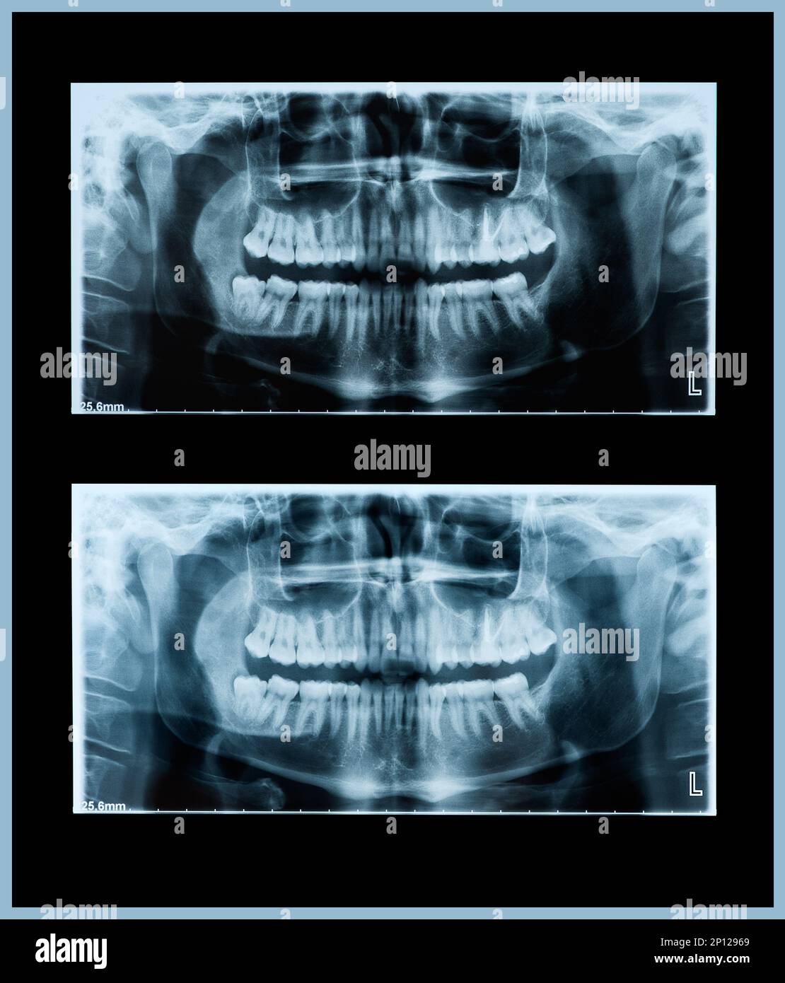 Panoramic dental xray image of teeth and mouth Stock Photo Alamy