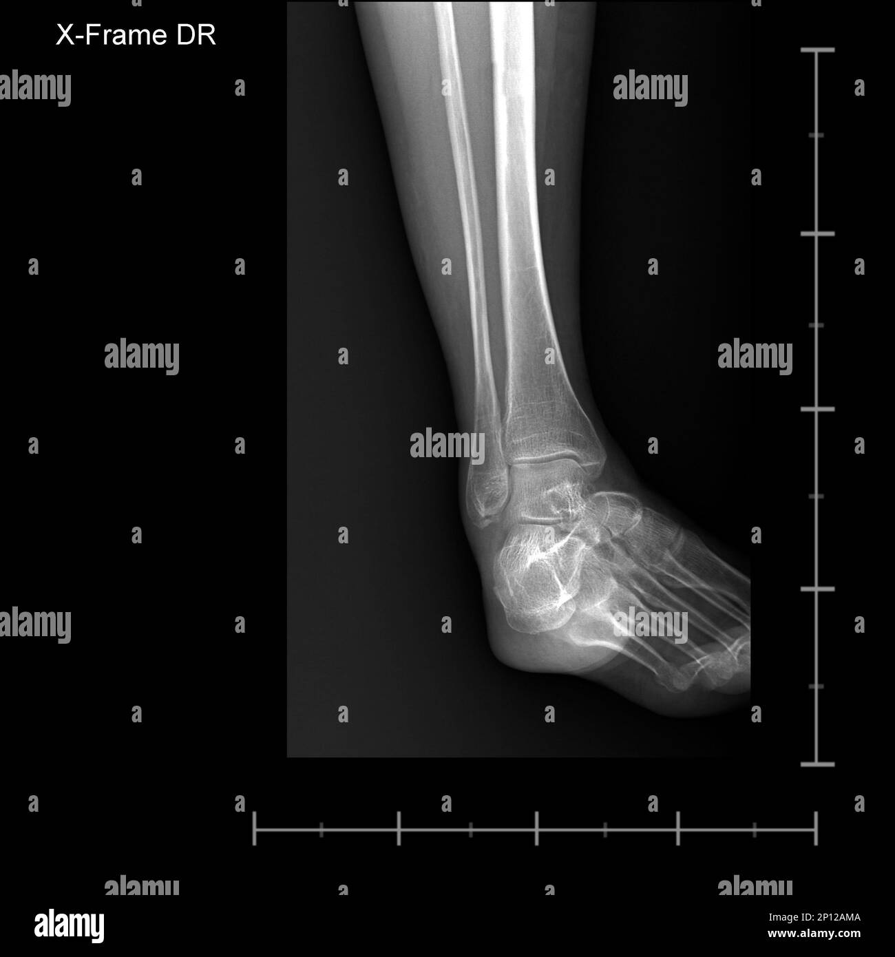 X-ray tarsal and ankle front Stock Photo