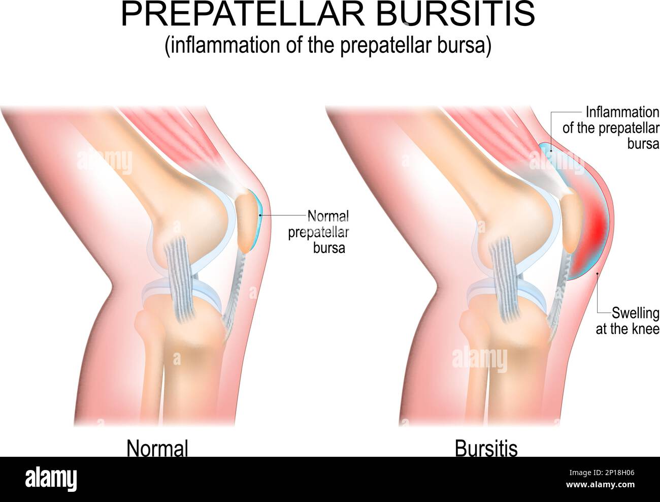 Prepatellar bursitis. inflammation of the prepatellar bursa. comparison of a human knee with Normal prepatellar bursa, and joint with Bursitis. vector Stock Vector