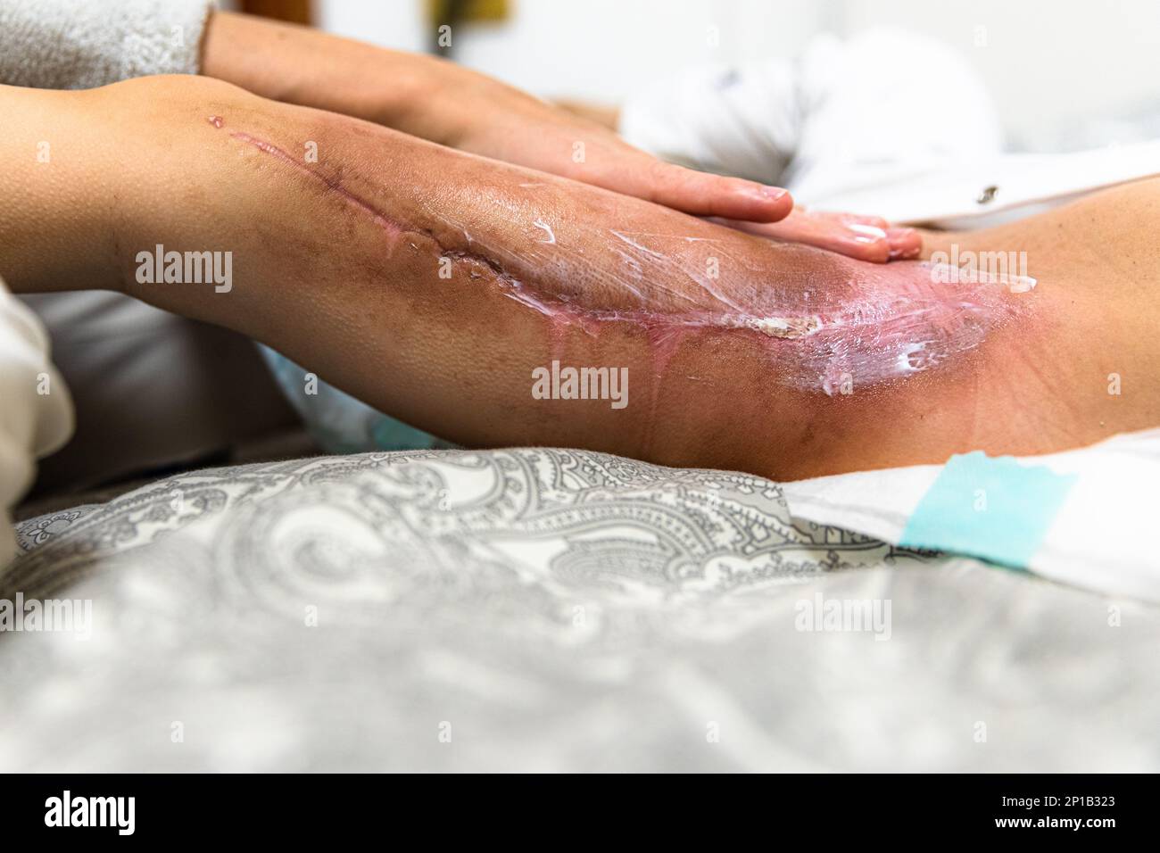 Cream treatment after radiotherapy with foot surgery in the treatment of alveolar rhabdomyosarcoma cancer Stock Photo