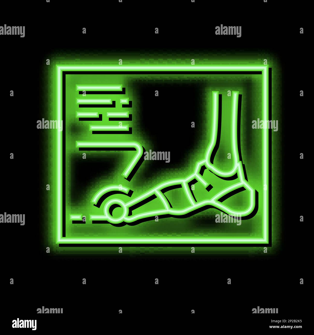 xray radiograph of foot gout diesase neon glow icon illustration Stock