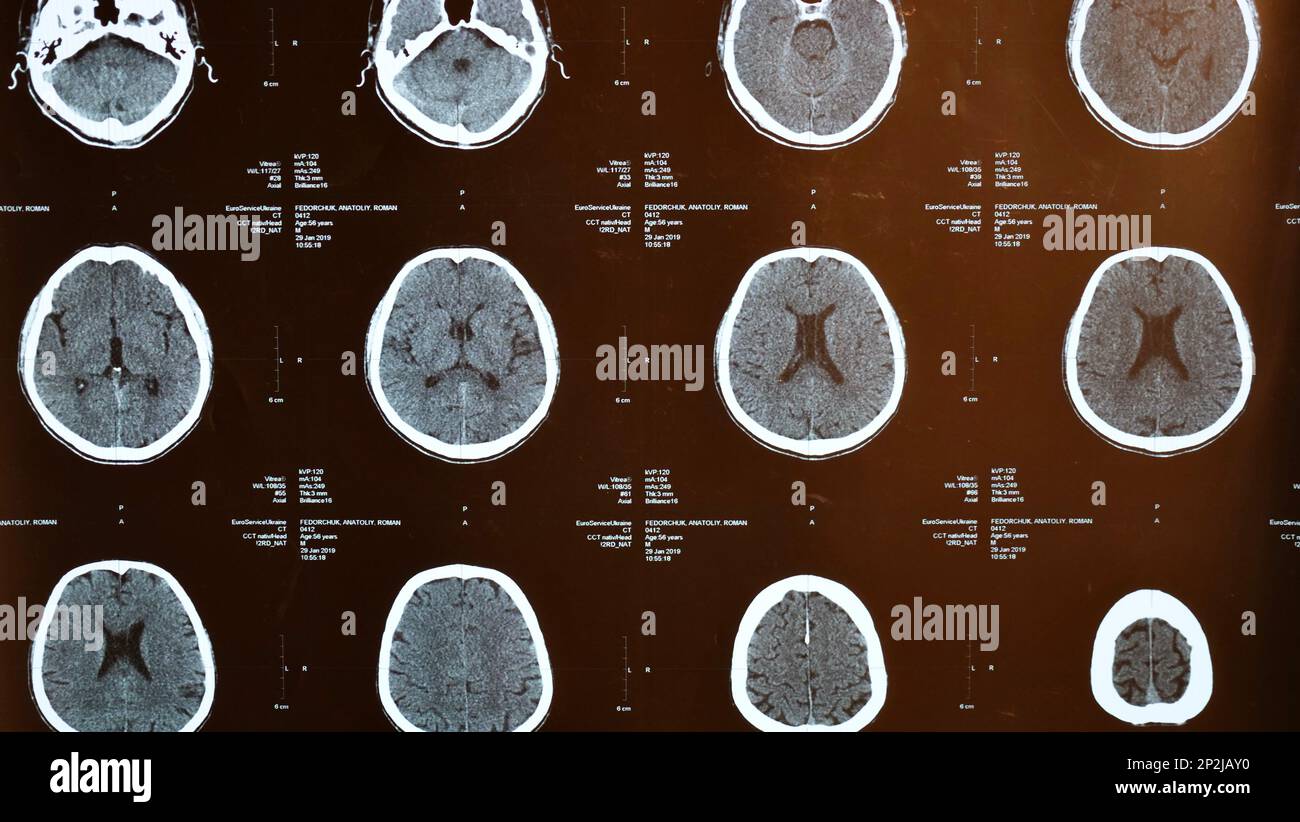 Magnetic resonance imaging, MRI of human brain after traumatic head