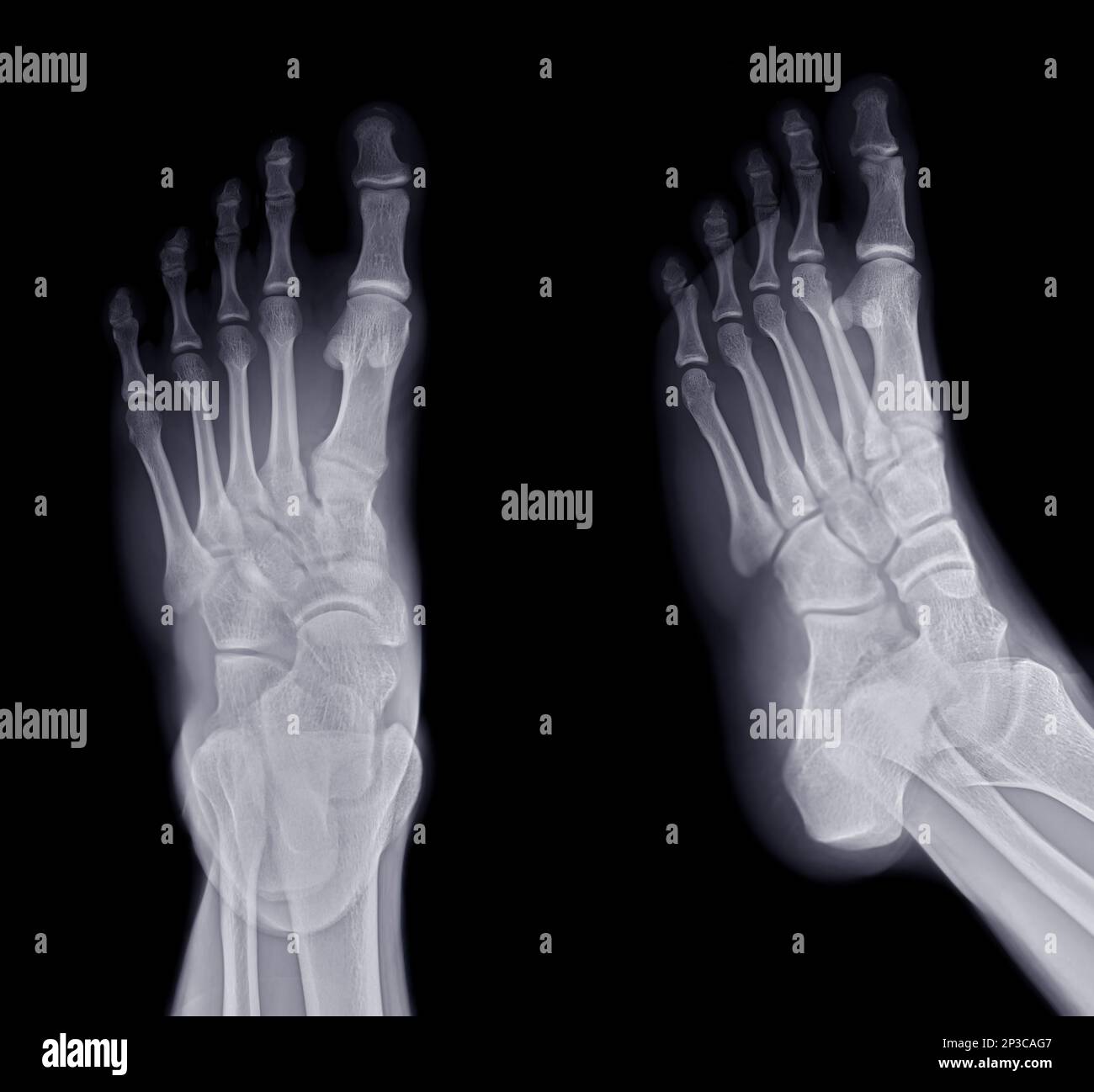 Foot x-ray image AP and Oblique  view  isolated on black background. Stock Photo