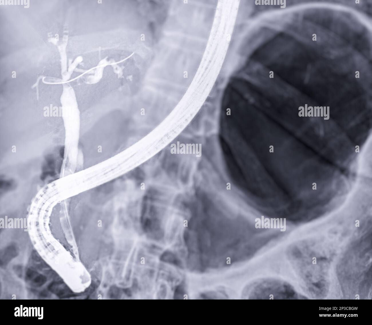 Xray image of endoscopic after Doctor doing ERCP and laparoscopic