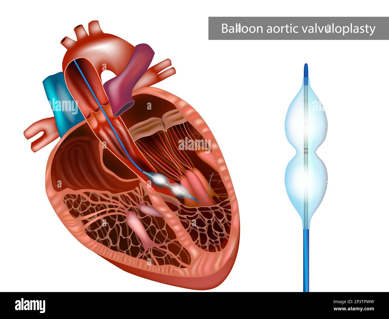 Balloon aortic valvuloplasty or BAV. The balloon catheter is advanced. Aortic stenosis, or narrowing of the aortic valve. Stock Vector