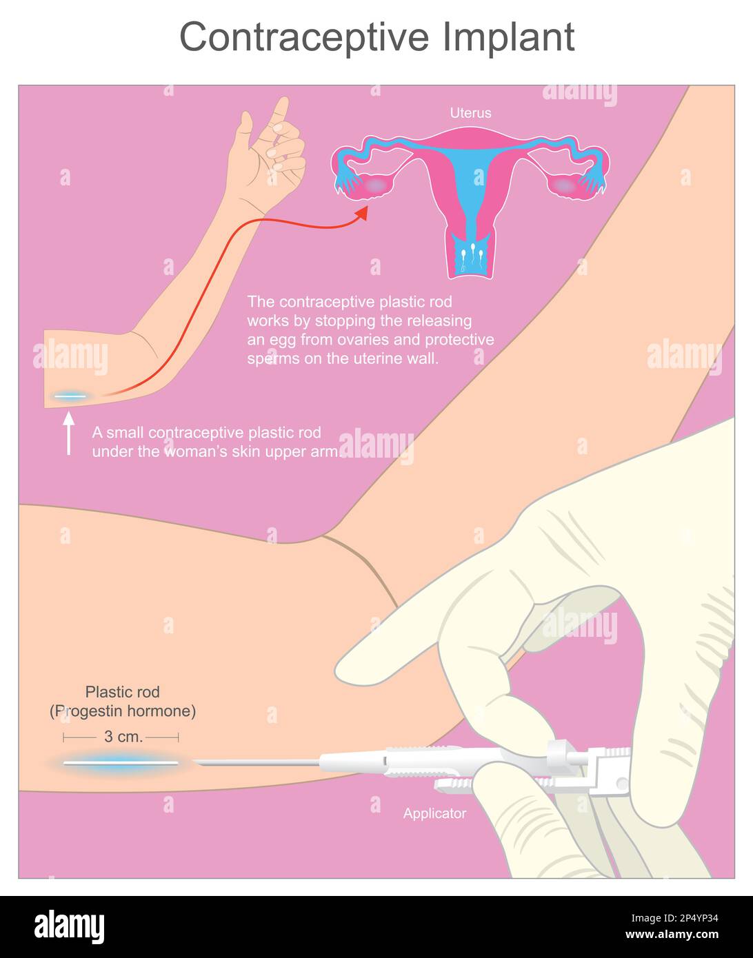 Contraceptive Implant. A small contraceptive plastic rod under the