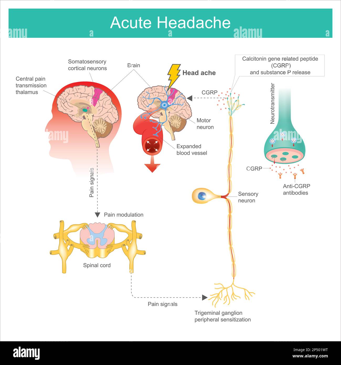 Acute Headache. Diagram learning The Acute Headache as a result a process of the brain and consequences expanded the blood vessel. Stock Vector