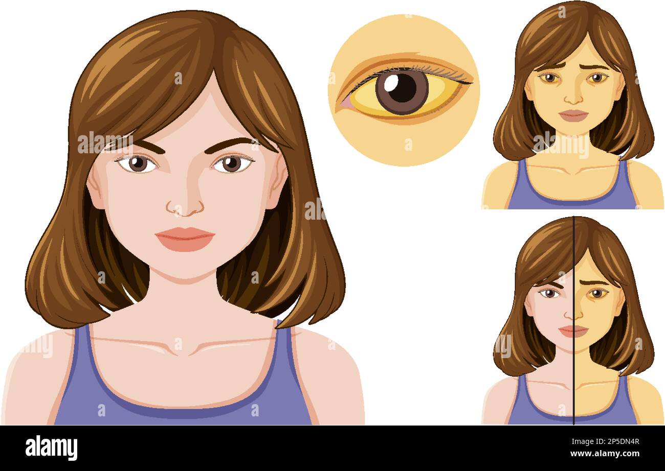 Jaundice disease vector concept illustration Stock Vector Image & Art