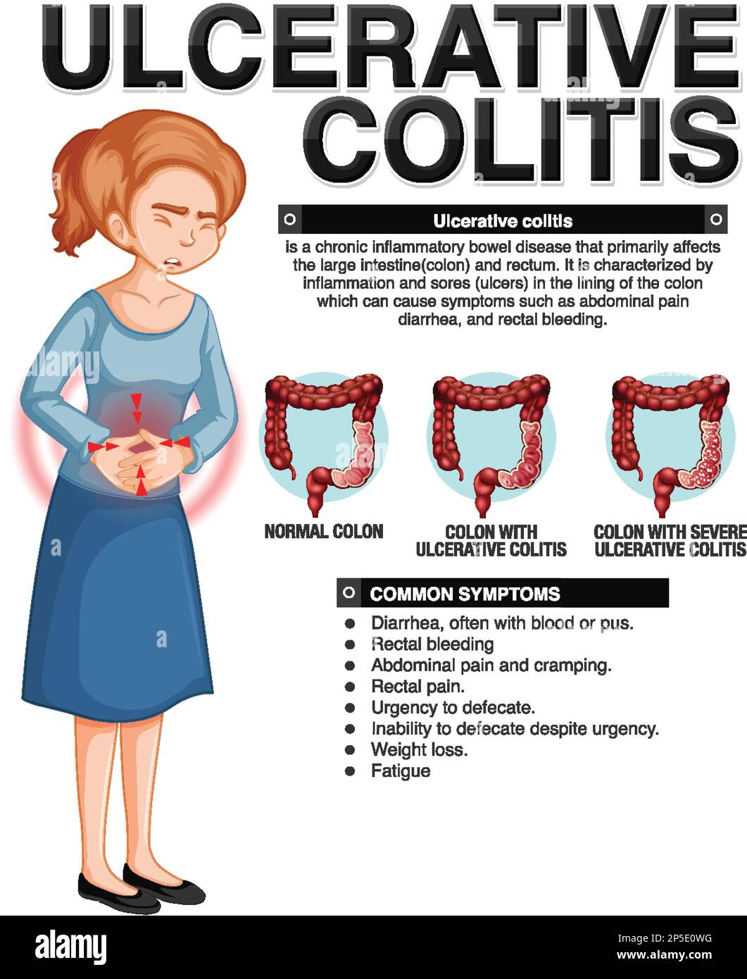 Ulcerative Colitis Symptoms Infographic Illustration Stock Vector Image ulcerative-colitis-symptoms-infographic-illustration-stock-vector-image