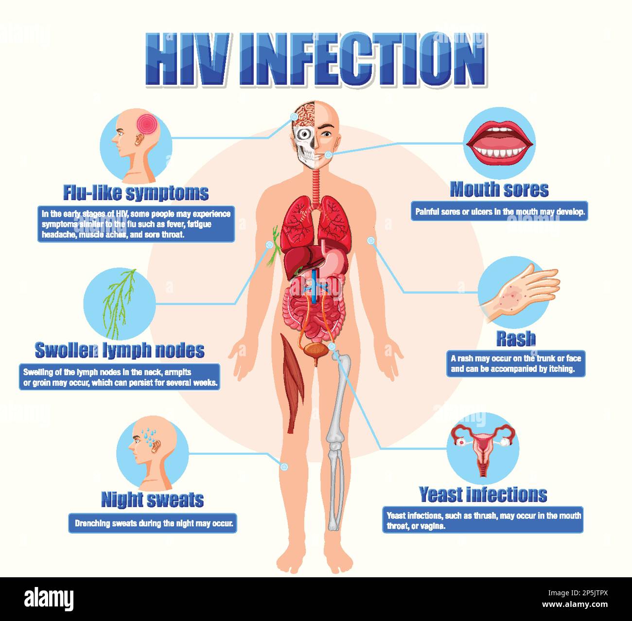 Informative poster of of HIV infection illustration Stock Vector Image ...