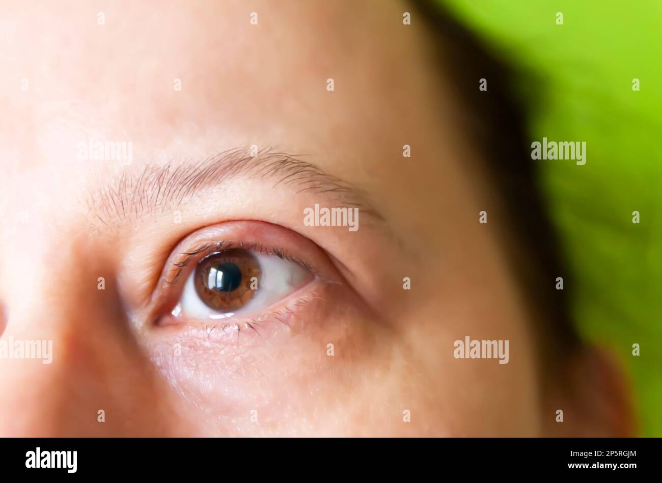 Barley disease in the eye. Sore eyelid. Stock Photo