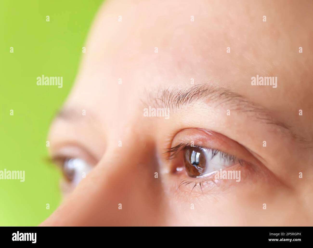 Barley disease in the eye. Sore eyelid. Stock Photo