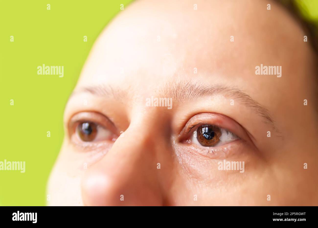 Barley disease in the eye. Sore eyelid. Stock Photo