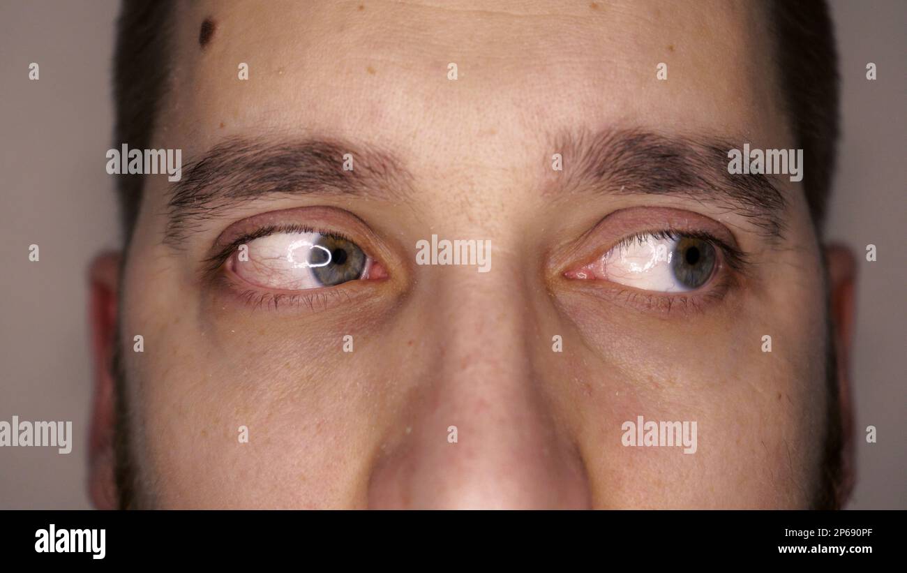 Green eyes closeup with capillaries. The concept of ophthalmology and