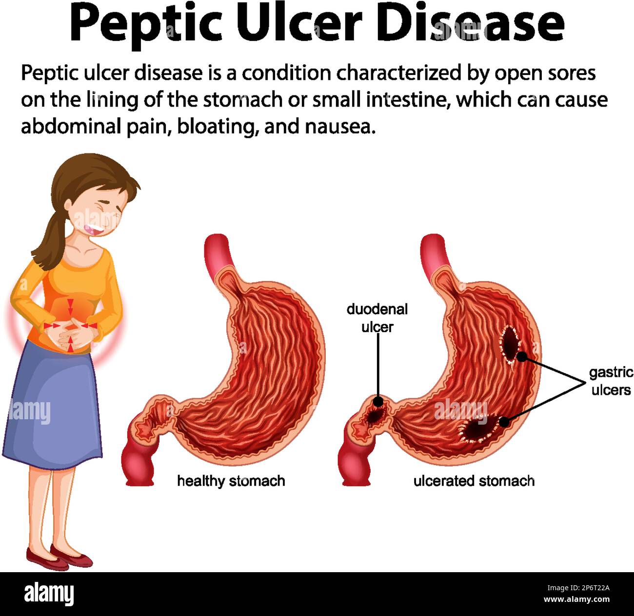 Peptic Ulcer Stomach Disease Infographic Poster Endos 