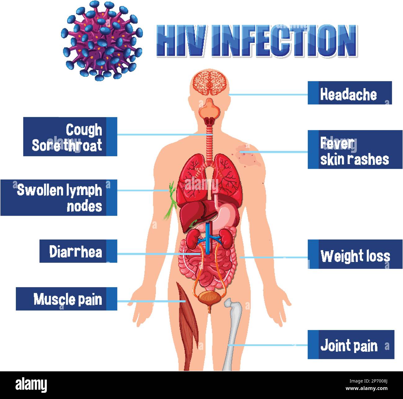 Informative Poster Of Of Hiv Infection Illustration Stock Vector Image