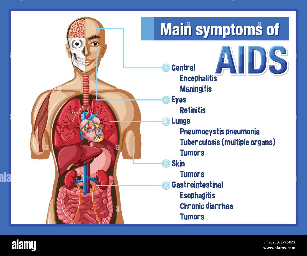 Informative poster of main symtoms of AIDS illustration Stock Vector