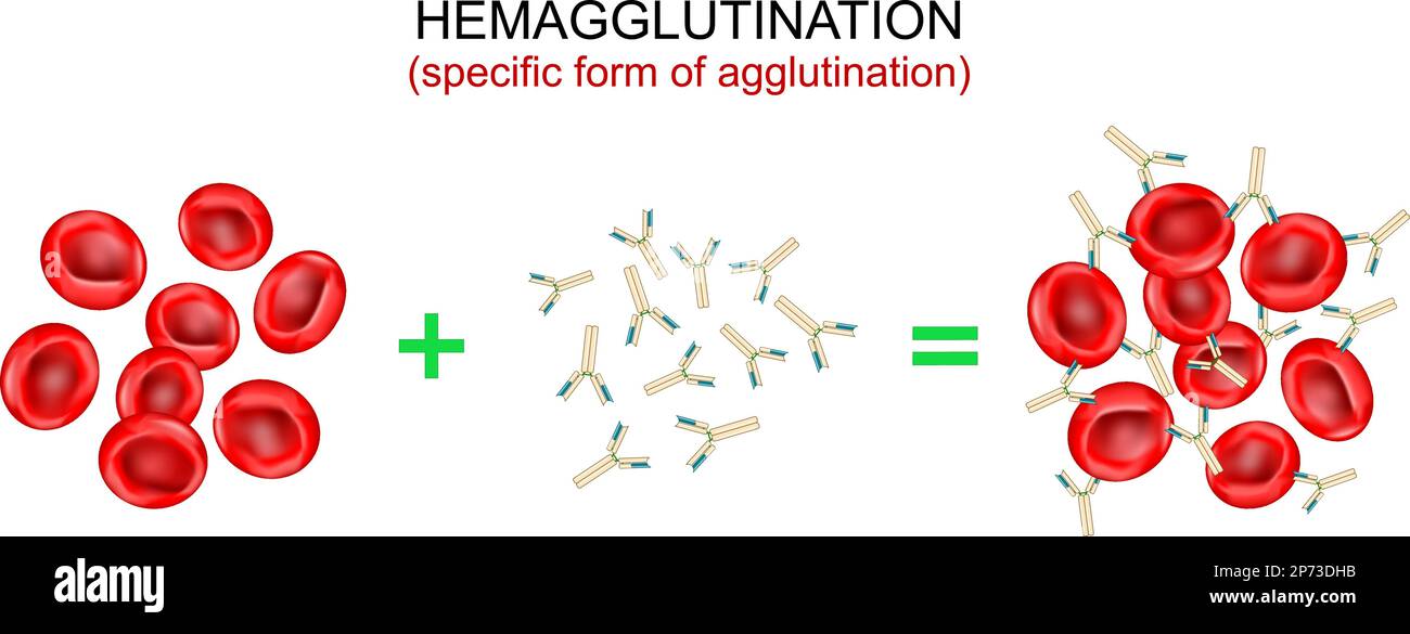 Hemagglutination, or haemagglutination. Specific form of agglutination. antibodies bind to antigens and form a clumping of erythrocytes. Blood type Stock Vector