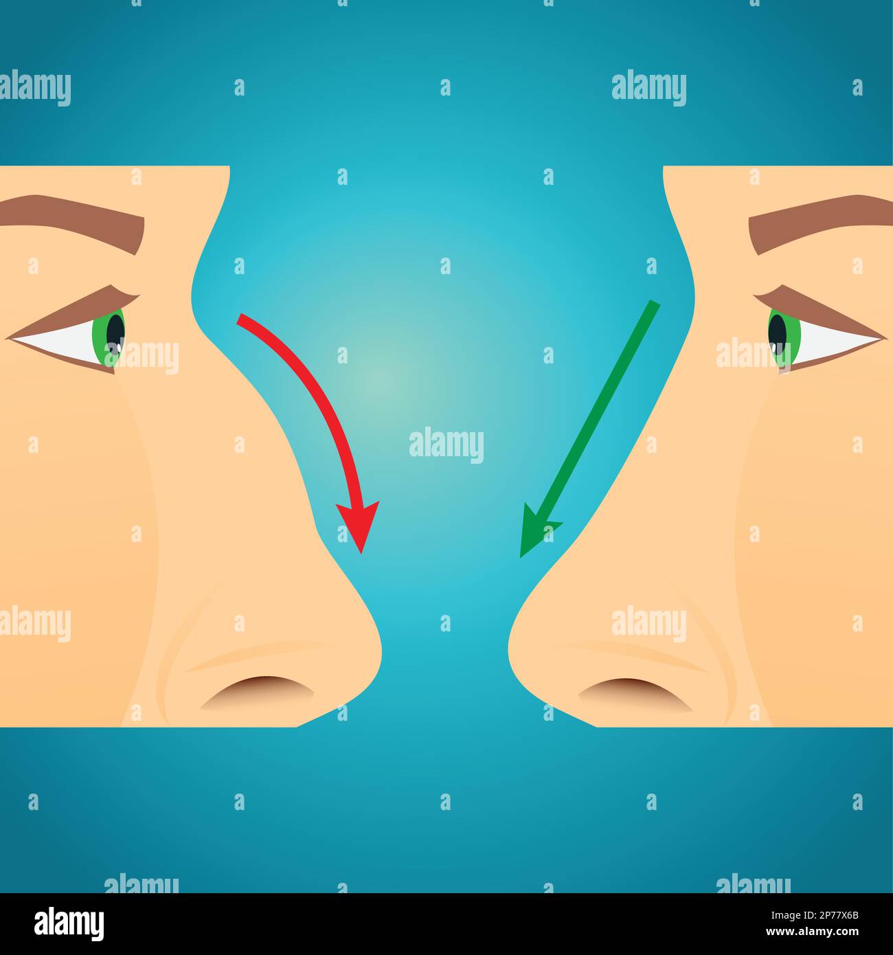 Rhinoplasty before and after images Stock Vector