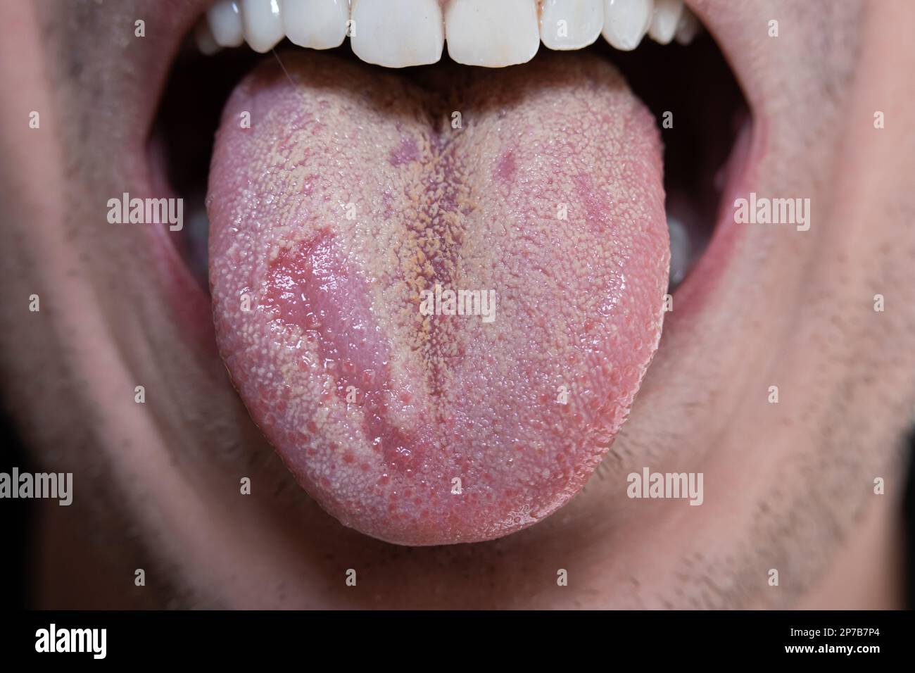Caucasian male tongue with yeast infection candida. Macro close up shot