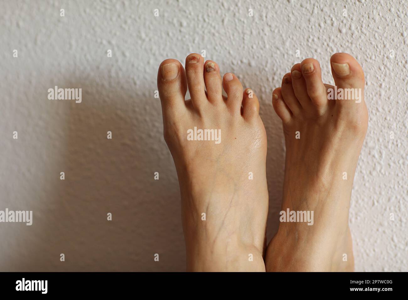 Female feet with subungual hematoma, black toenails caused by trauma