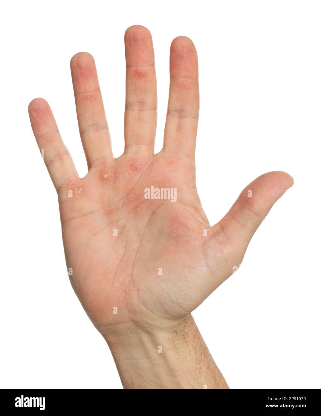 Man suffering from calluses on hand against white background, closeup