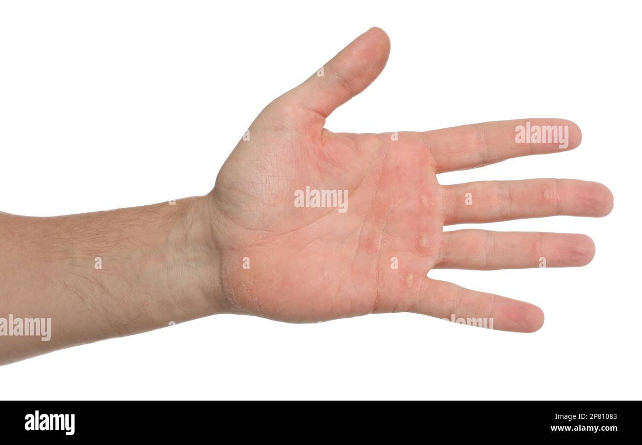 Man suffering from calluses on hand against white background, closeup