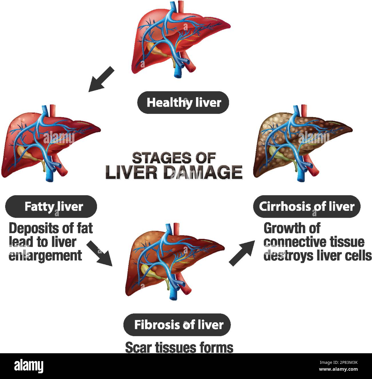Stages Of Liver Damage Infographic Illustration Stock Vector Image stages-of-liver-damage-infographic-illustration-stock-vector-image