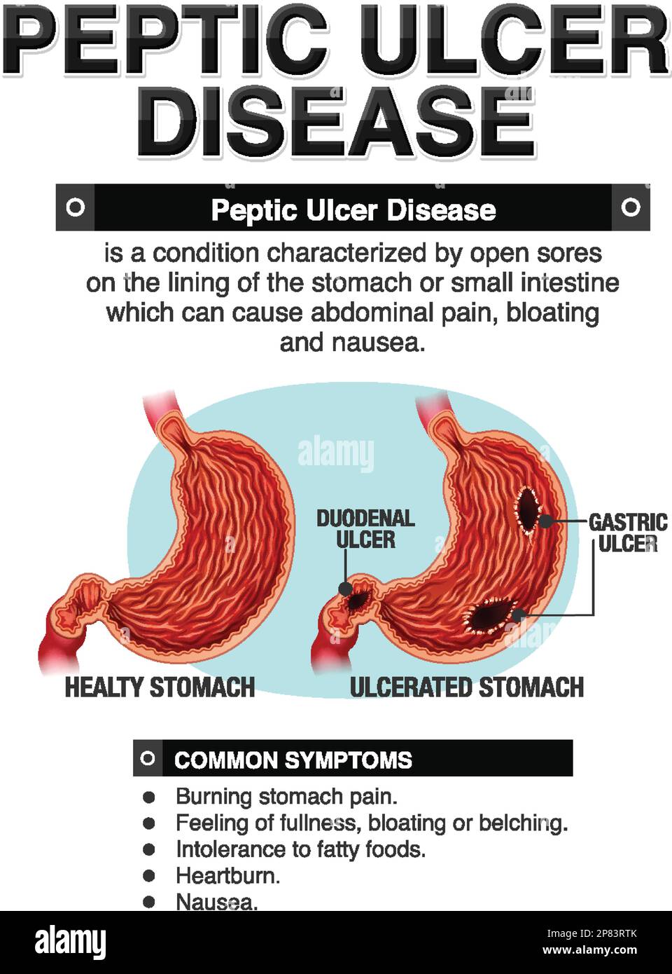 Peptic Ulcer Stomach Disease Infographic Poster Endos