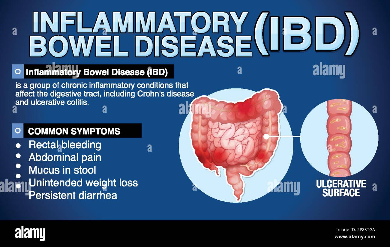 Inflammatory Bowel Disease Ibd Infographic Illustration Stock Vector