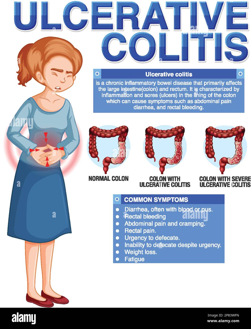 Ulcerative Colitis Symptoms Infographic illustration Stock Vector