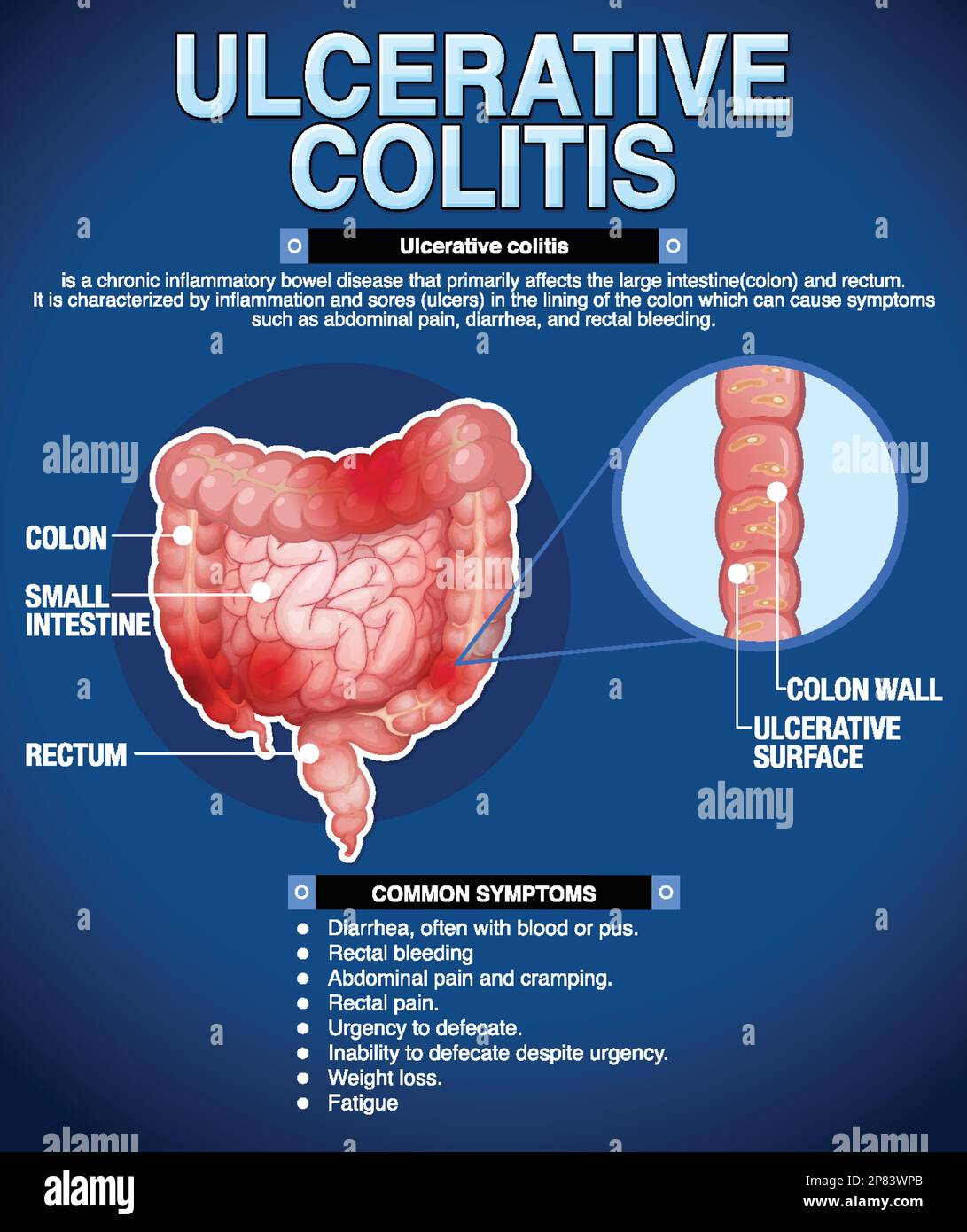 Ulcerative Colitis Symptoms Infographic illustration Stock Vector