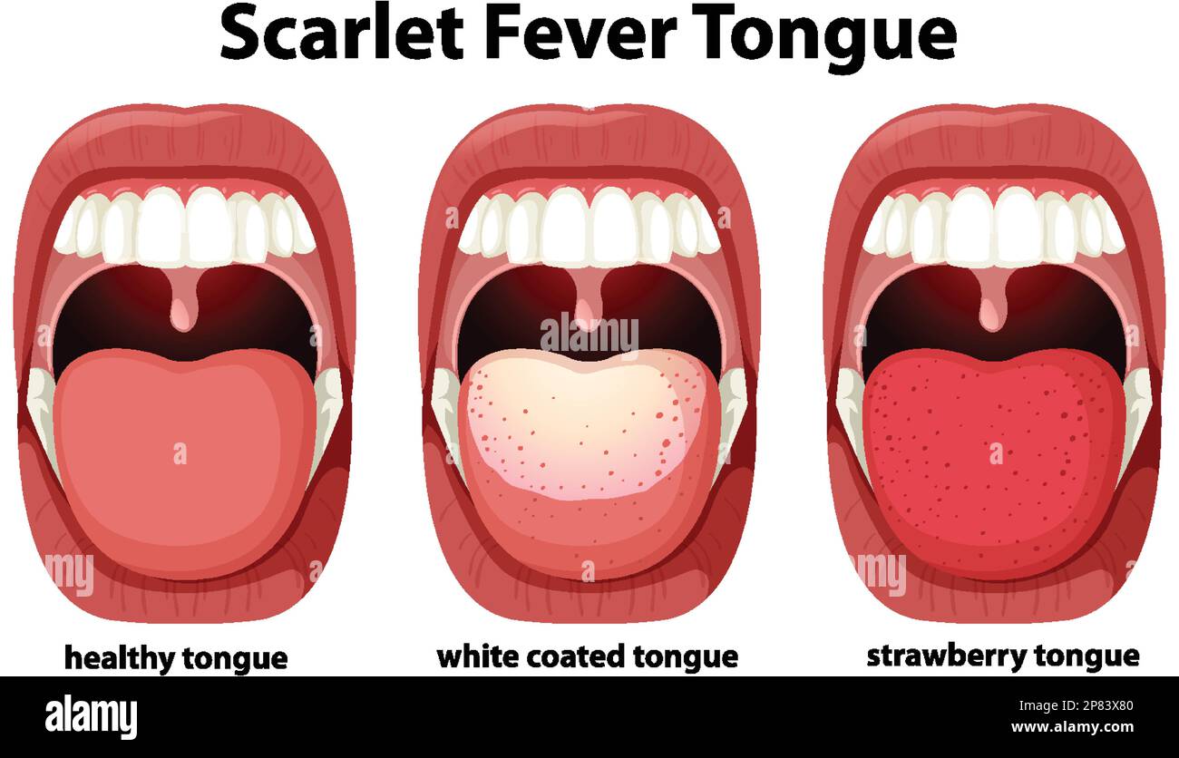 Scarlet fever mouth with symptoms of scarlatina Vector Image