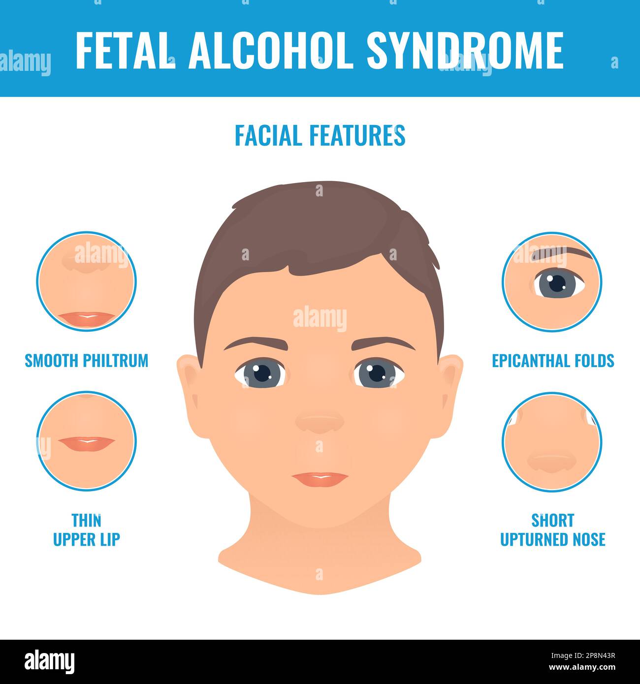 Fetal alcohol syndrome facial features in a child Stock Vector